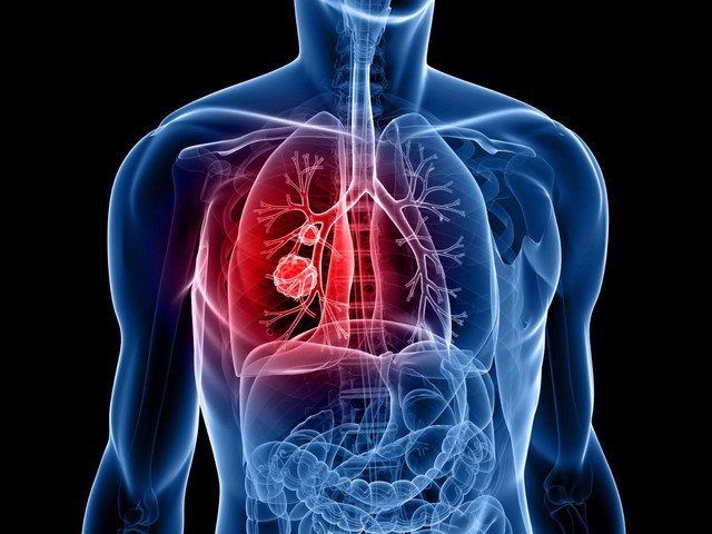 Tăng cường tầm soát ung thư phổi để tăng cơ hội sống cho bệnh nhân - Ảnh 1.