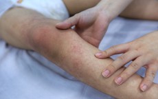 TPHCM: Dịch sốt xuất huyết giảm, bệnh tay chân miệng tăng